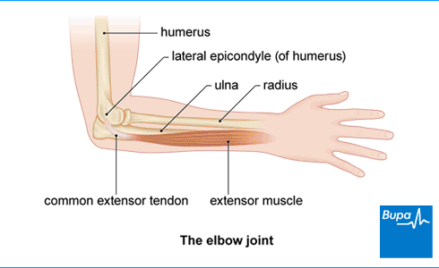 Read more about the article Tennis elbow