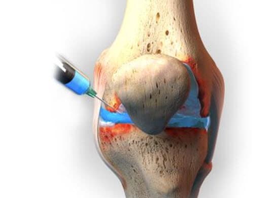 Read more about the article Stages of Knee Osteoarthritis provided by Bioventus. Hyaluronon injection is one of few but the safest way to improve the mobility and pain in joints