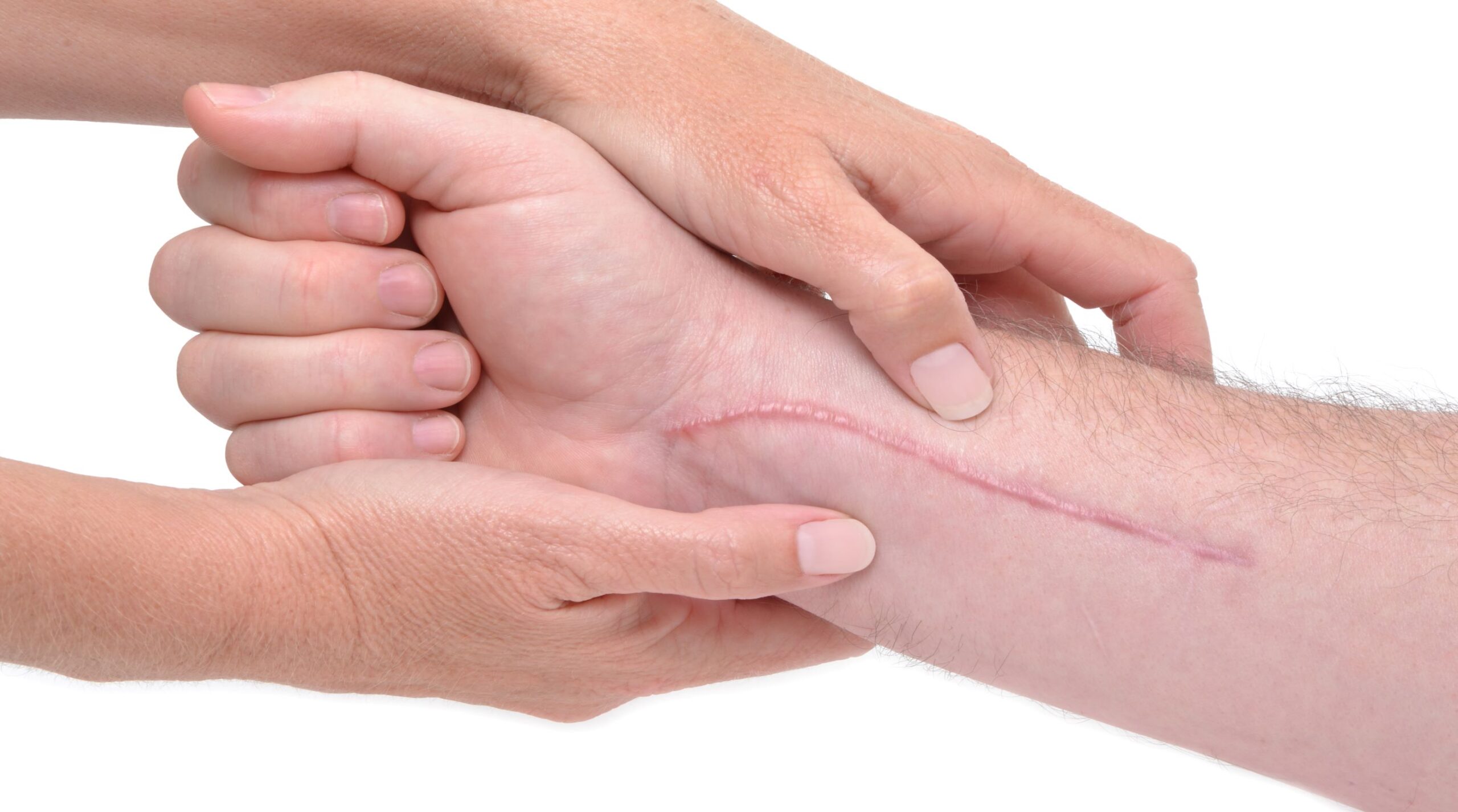 Read more about the article SCAR MOBILIZATION